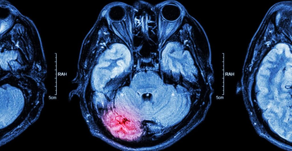 Traumatic Brain Injury Imaging